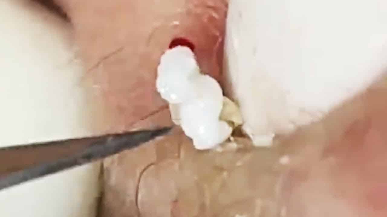 Deep blackhead extraction Cystic acne & pimple popping #51