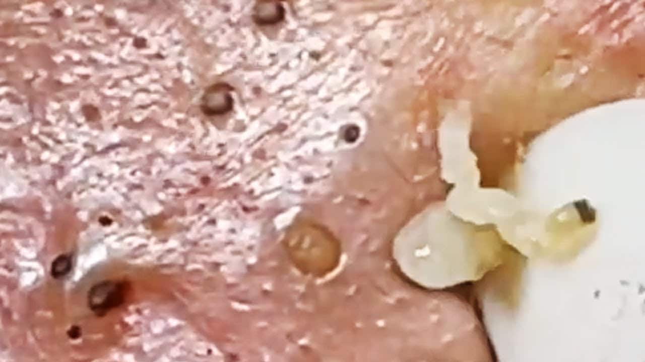 Deep blackhead extraction Cystic acne & pimple popping #45