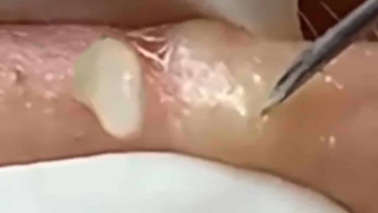 Deep blackhead extraction Cystic acne & pimple popping #43