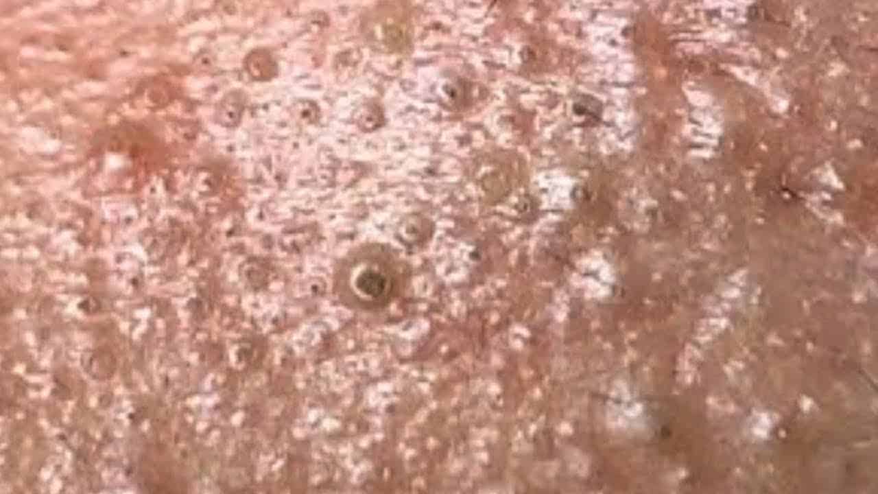 Deep blackhead extraction Cystic acne & pimple popping #30