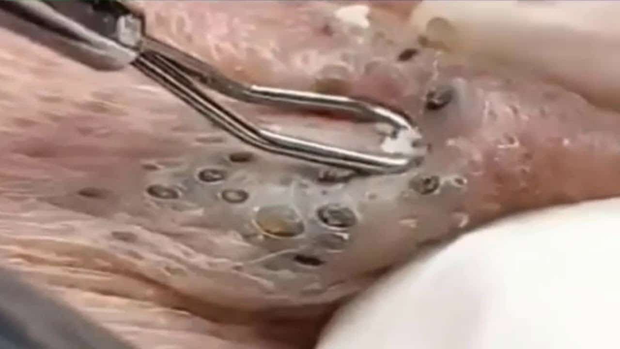 Deep blackhead extraction Cystic acne & pimple popping #28