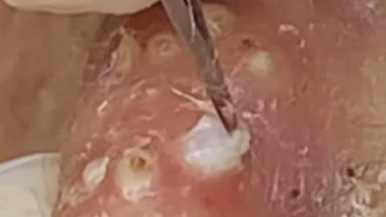 Deep blackhead extraction Cystic acne & pimple popping #25