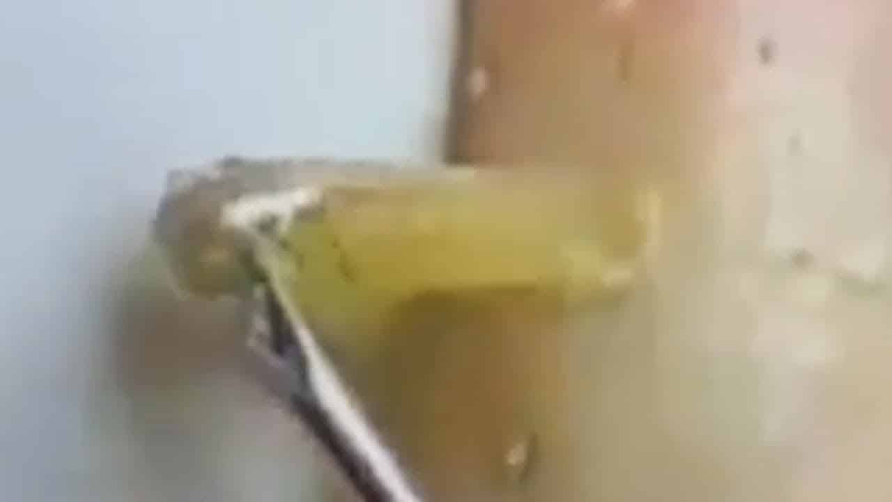 Deep blackhead extraction Cystic acne & pimple popping #13