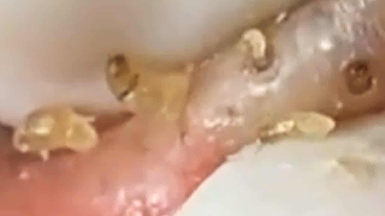 Deep blackhead extraction Cystic acne & pimple popping #11