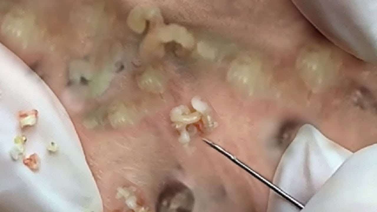 Deep blackhead extraction Cystic acne & pimple popping #1
