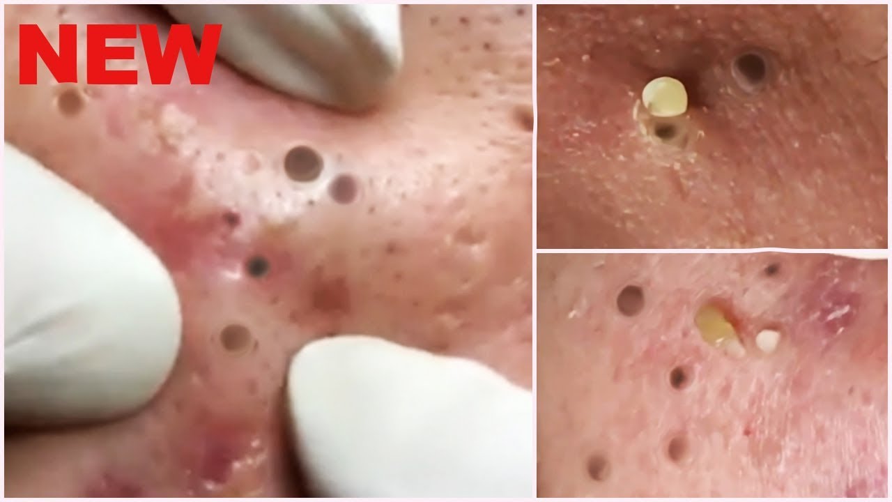 Deep Blackheads Removal from Cheeks and Nose – Best Pimple Popping Videos
