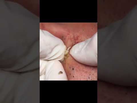 Deep Blackheads removal/ pimple popping / Acne treatment