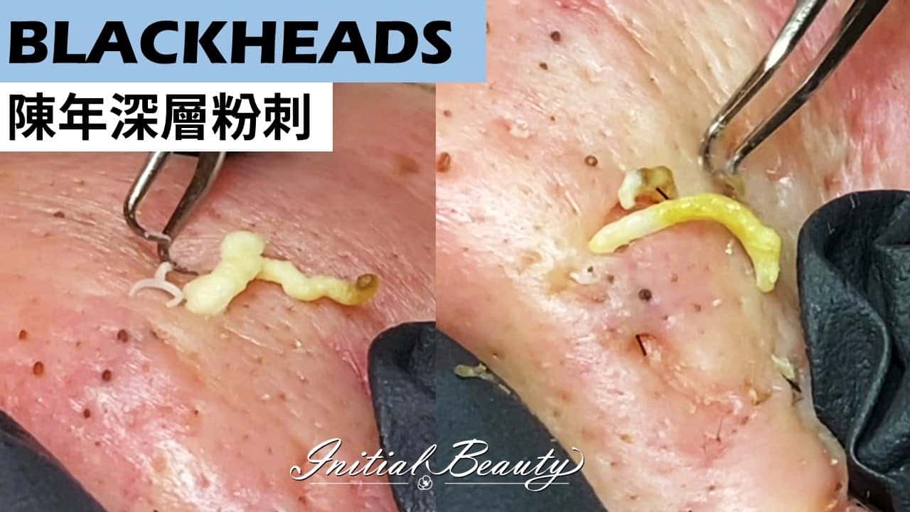 陳年深層粉刺( deep blackheads ) – Taiwan Tainan台南清粉刺最乾淨