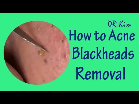 Deep Blackheads & Whiteheads, Large Blackheads Extraction Best Pimple Popping