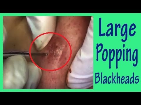 Deep Blackheads & Whiteheads, Large Blackheads Pimple Popping-Blackheads Removal