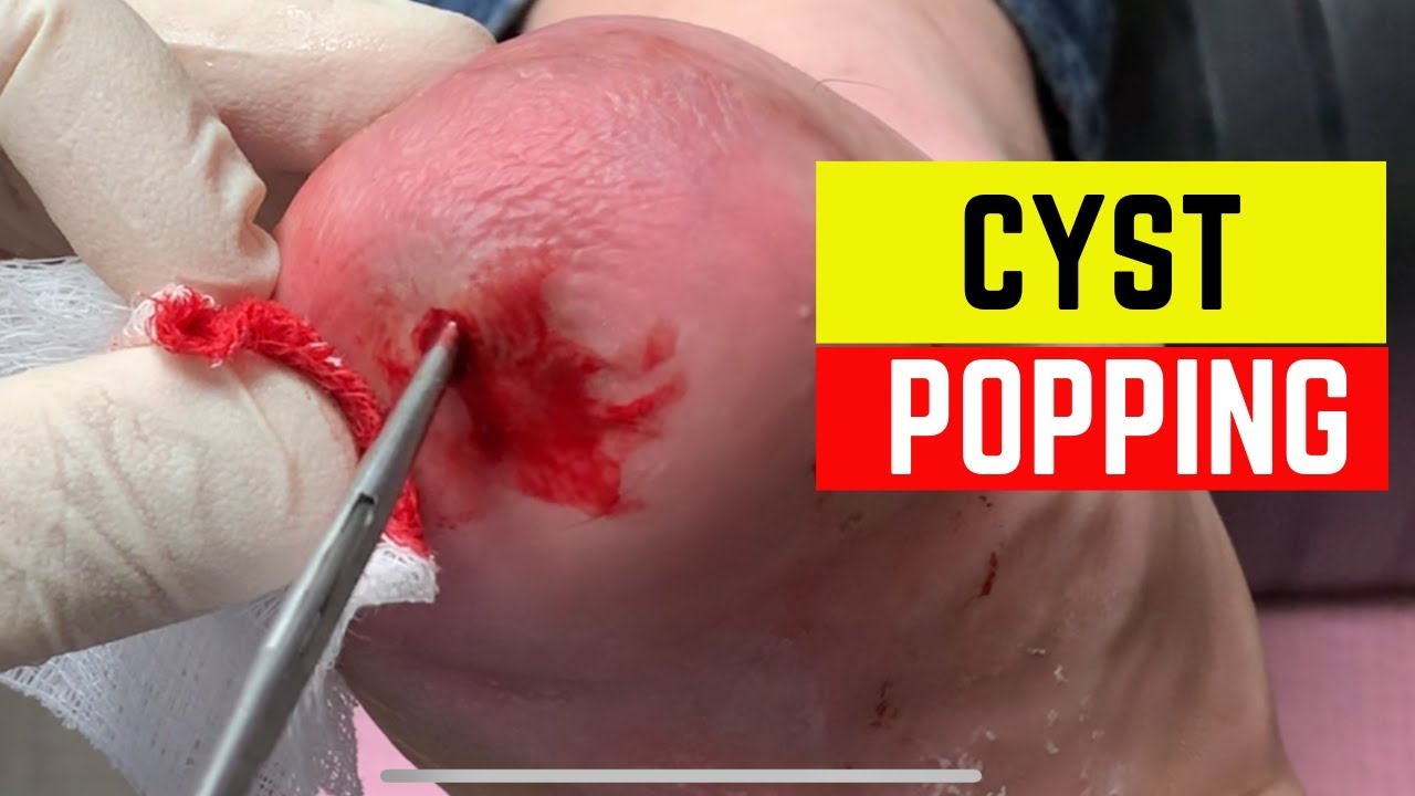 Deep Cyst Popping. Wound Cleaning