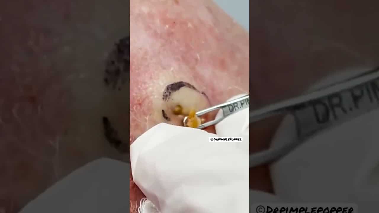DEEP Dilated Pore of Winer | Dr. Pimple Popper #shorts #drpimplepopper #pimplepopping #pimples