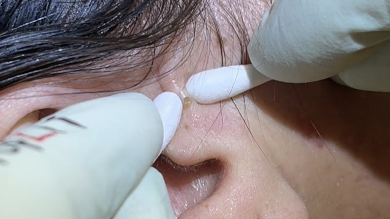 Deep embedded neck Blackheads with ingrown hairs popped out. Whiteheads, milia, pustules extracted.