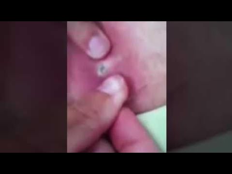 DEEP PIMPLE CYST POPPING WITH LOTS OF PUS 2014    -All pimples of the earth-