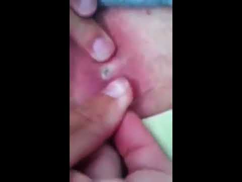 DEEP PIMPLE CYST POPPING WITH LOTS OF PUS 2016 YouTube