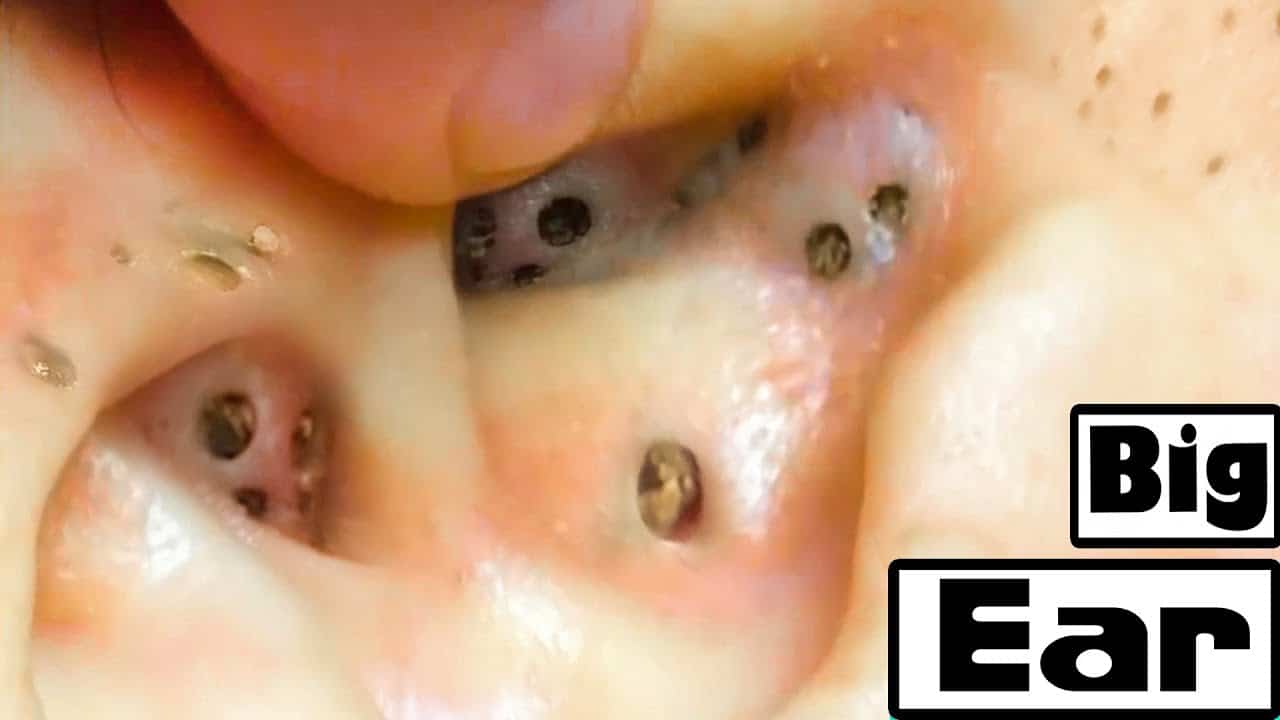 Deep Removal Of Blackheads In The Ear