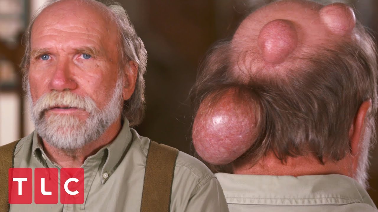 Dennis Has Giant Growths on His Head | Dr. Pimple Popper