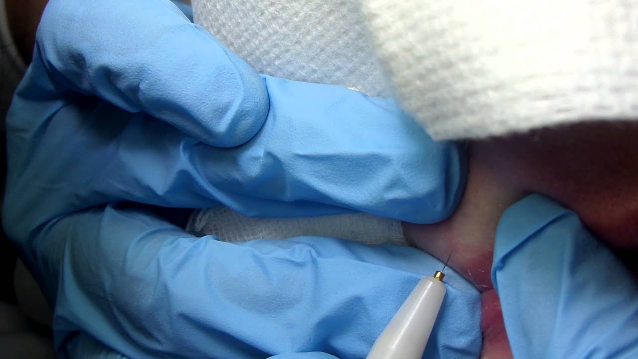 Depilación eléctrica en labio superior de mujer (pelusa de melocotón)
