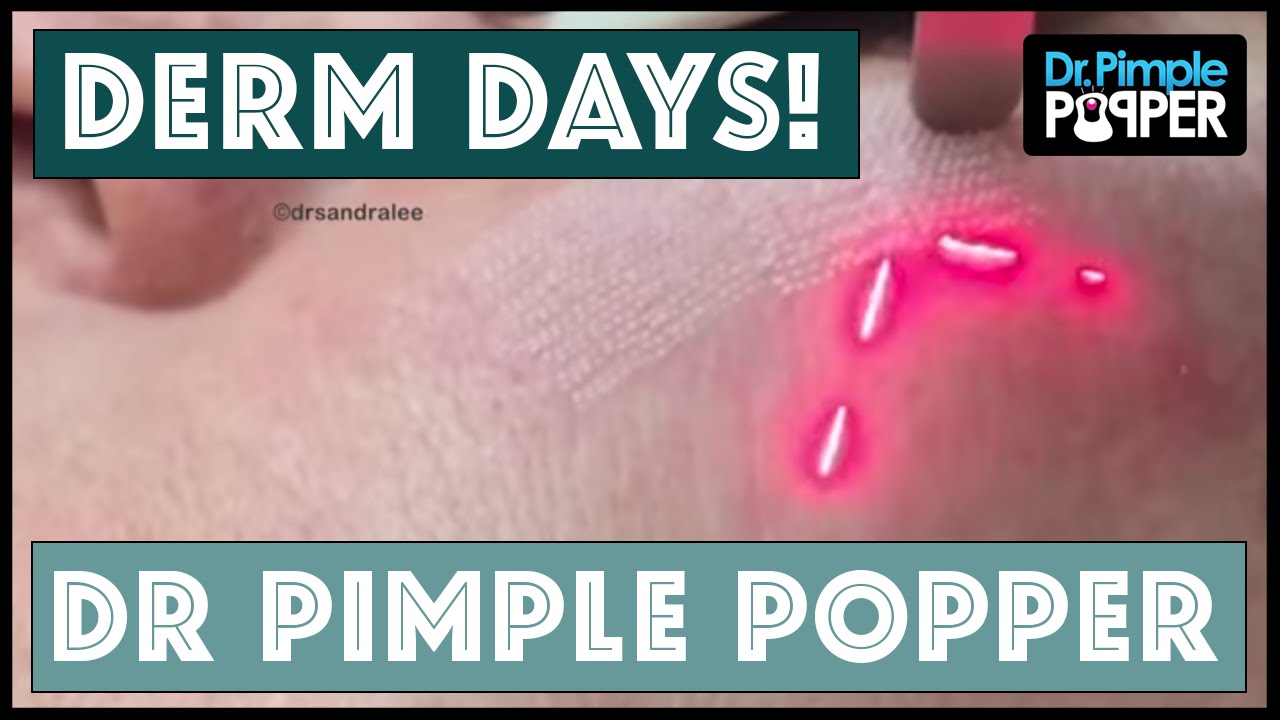 Derm Days with Dr. Pimple Popper!
