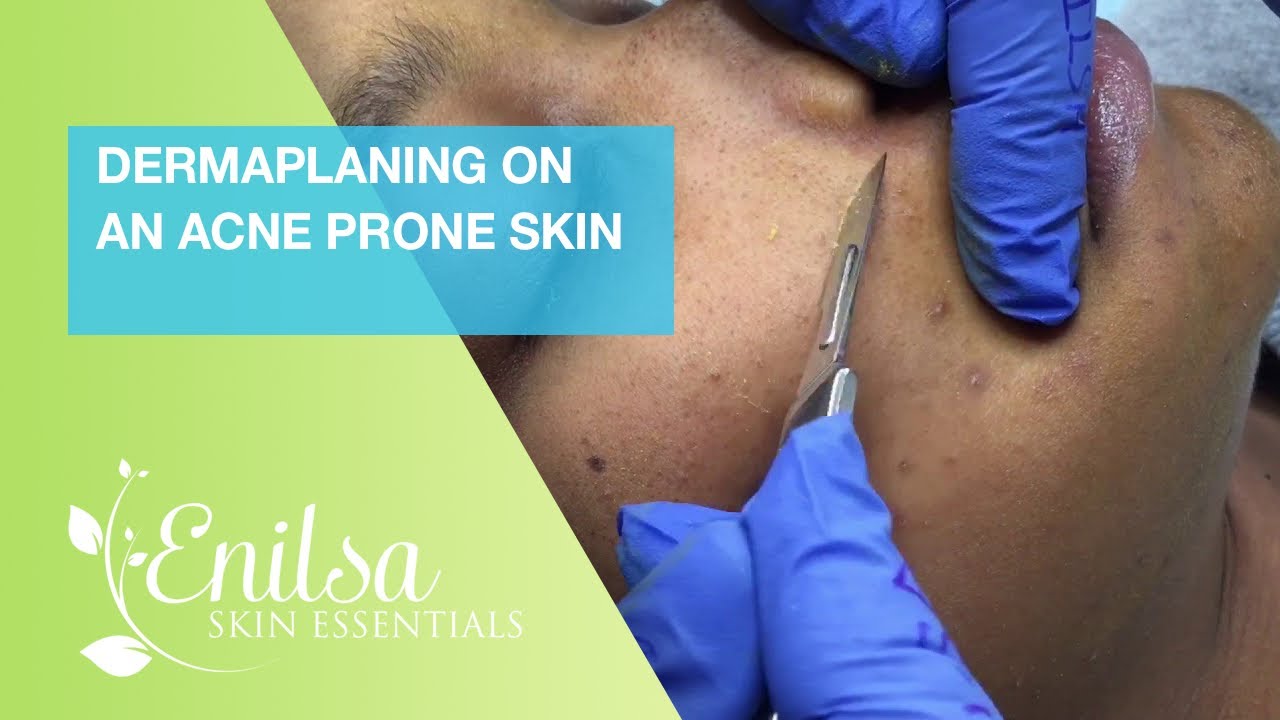 Dermaplaning On An Acne Prone Skin