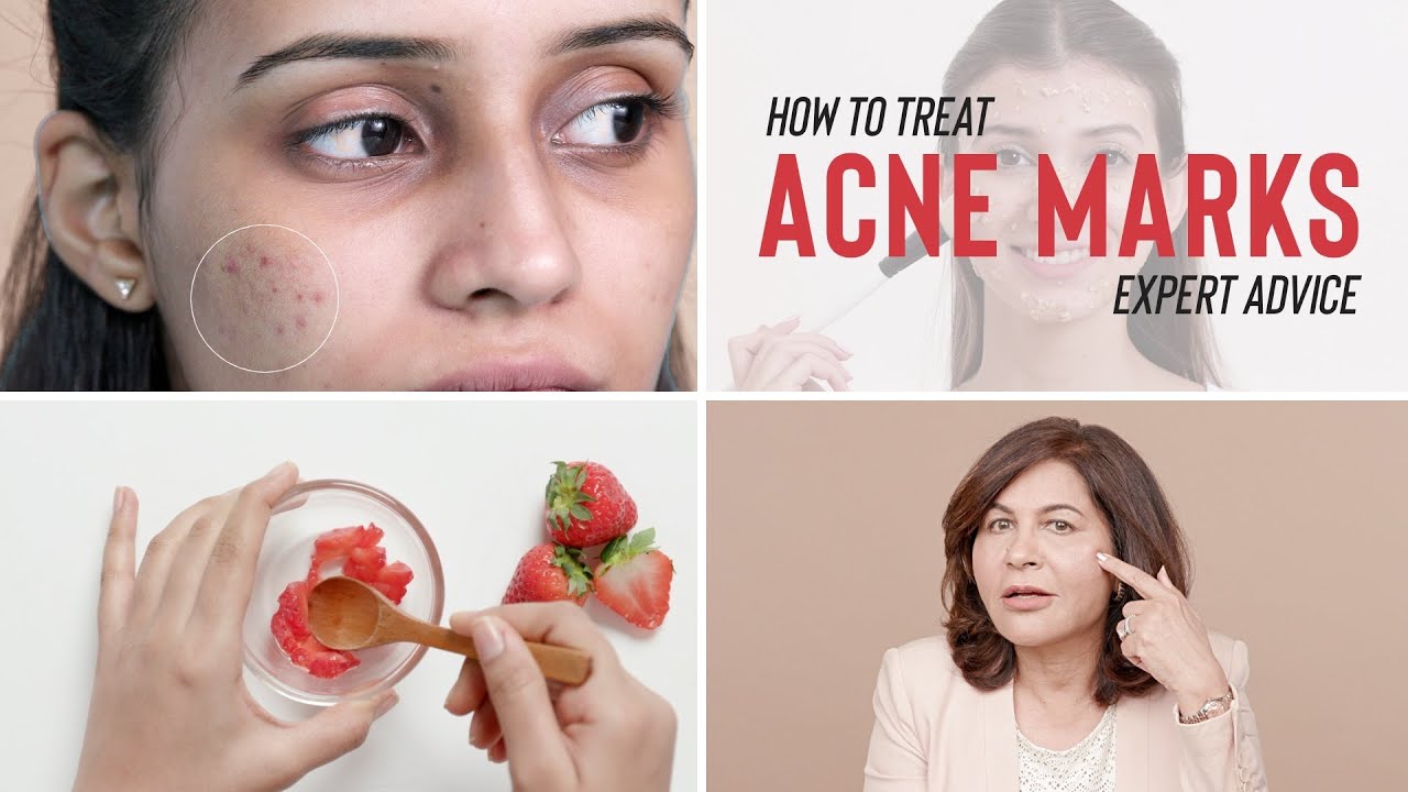 Dermatological Treatments For ACNE MARKS