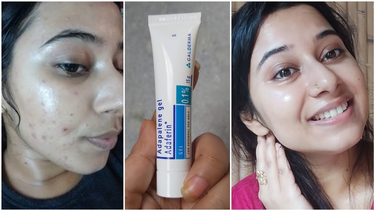 Dermatologist Recommended Best Cream to Remove Pimple Marks, Dark spots,Pigmentation, acne scars