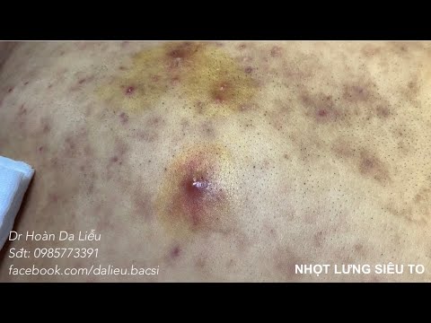 Dermatologist treating squeeze pimples, whitehead blackhead, pustule, anti acne| Nặn nhọt lưng to