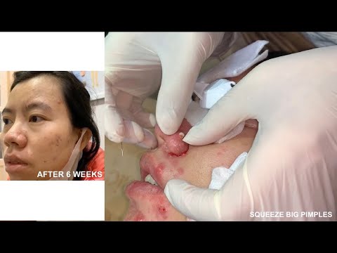 Dermatologist treating squeeze pimples, whitehead blackhead, pustule, anti acne after 6 weeks nose