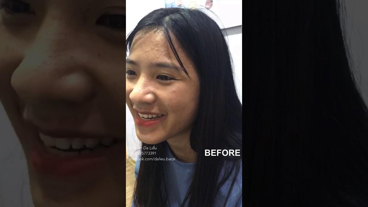 Dermatologist treating squeeze pimples, whitehead blackhead, pustule, anti acne after 3 weeks