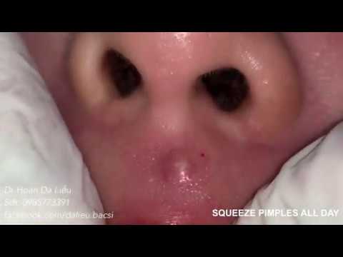 Dermatologist treating squeeze pimples, whitehead blackhead, pustule, anti acnes all day|Nặn mụn to