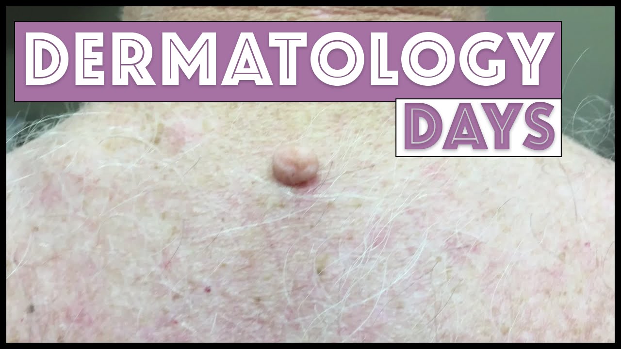 Dermatology Days – A sampling of patients I see in a day