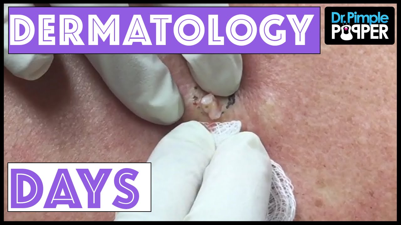 Dermatology Days with Dr Pimple Popper
