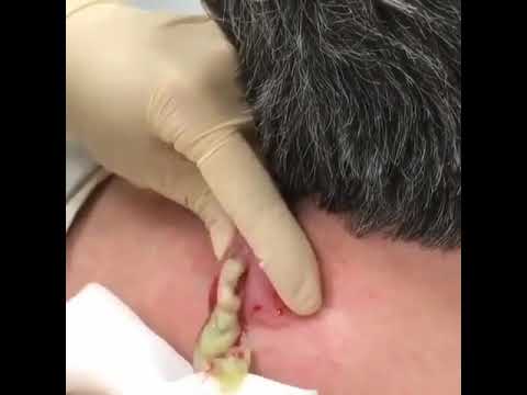 dermatology : Large Cyst popping