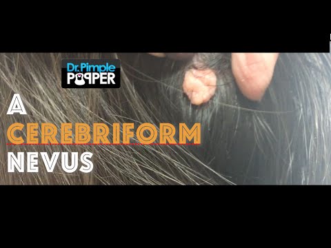 Dermatology: Removing a cerebriform nevus on the scalp