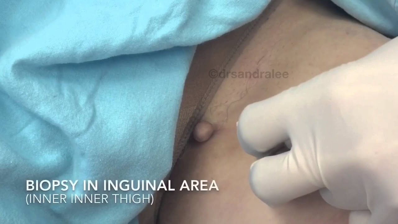 Dermatology: Removing a growth from the inguinal area. For medical education- NSFE.