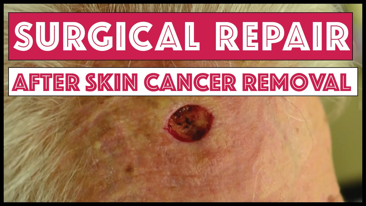 Dermatology: Surgical repair after removal of skin cancer on forehead