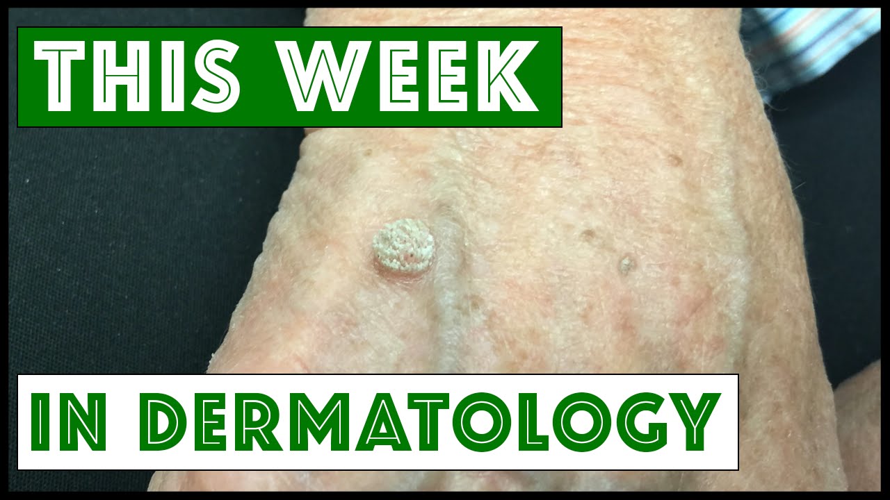 Dermatology This Week: Various dermatologic procedures
