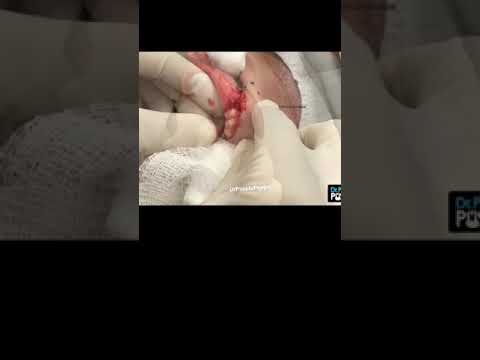 Did you spot this inflamed cyst? | Dr. Pimple Popper #shorts #drpimplepopper