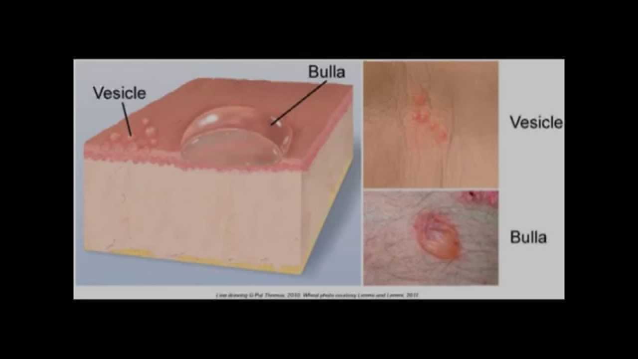 different type skin lesions and their morphology :macule, papule ,vesicle, pustule