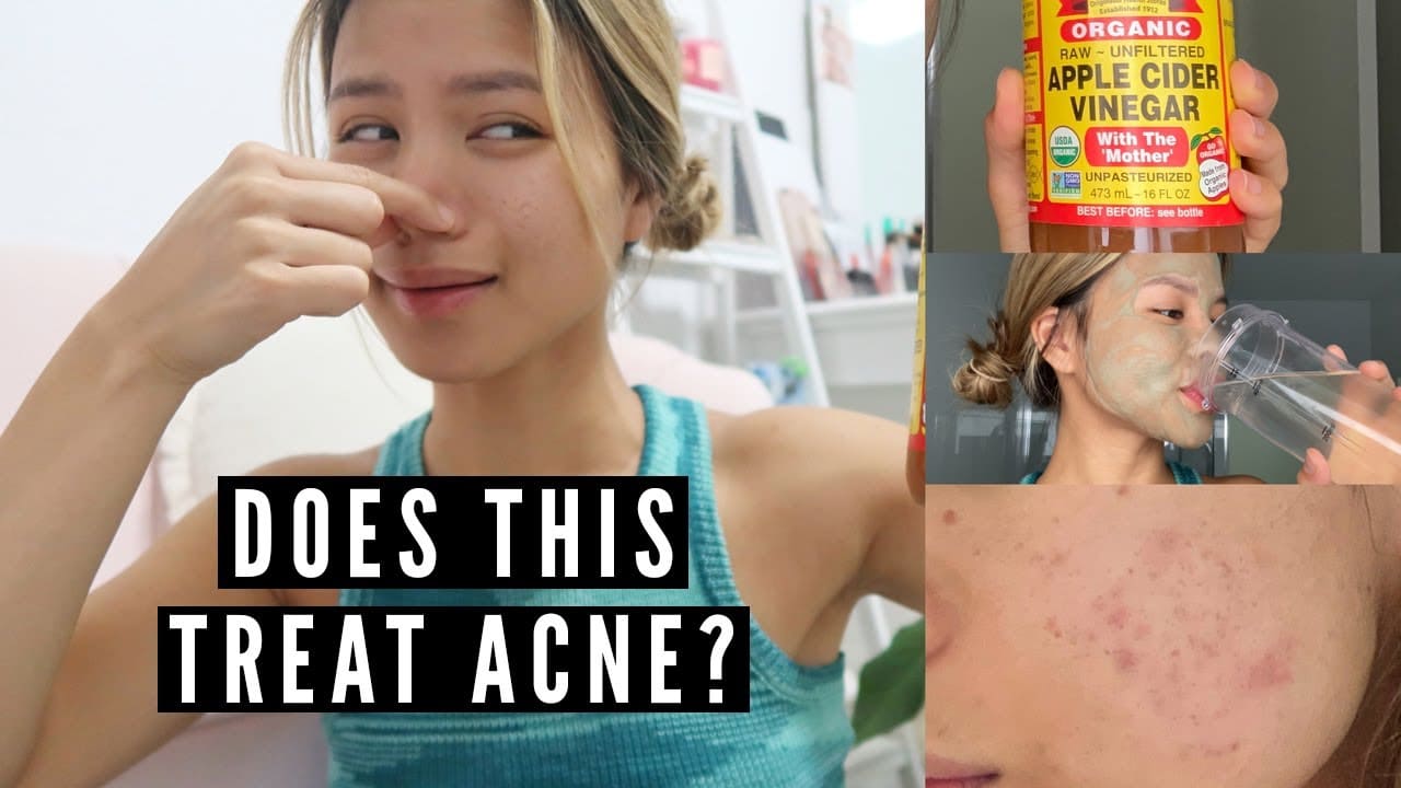 Different Ways to Treat Acne With Apple Cider Vinegar