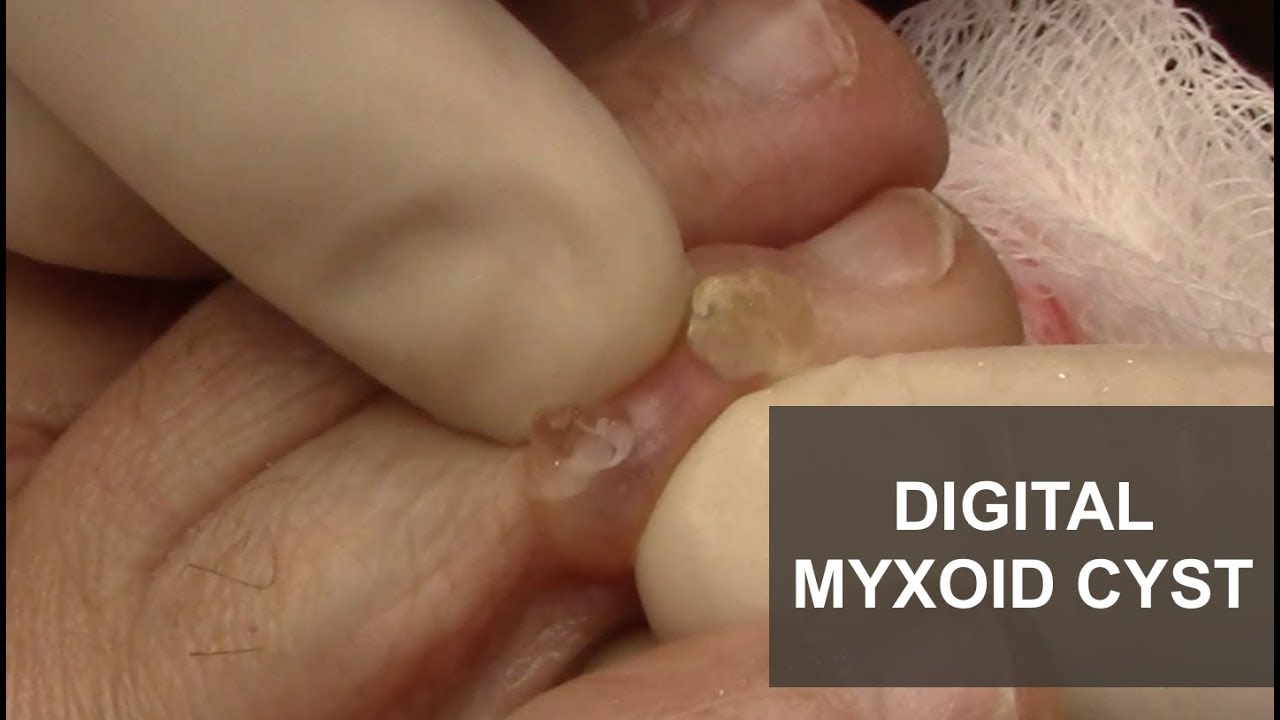 Digital Myxoid Cyst | Dr. Derm