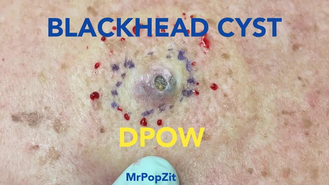 Dilated pore of winer (DPOW) blackhead cyst. Large clogged pore with 2cm cyst underneath. MrPopZit