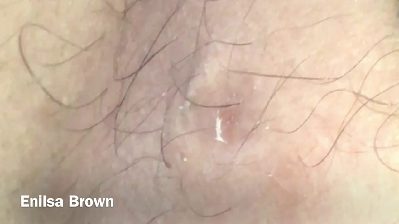 Dilated Pore Of Winer Extraction (Oversized Blackhead)