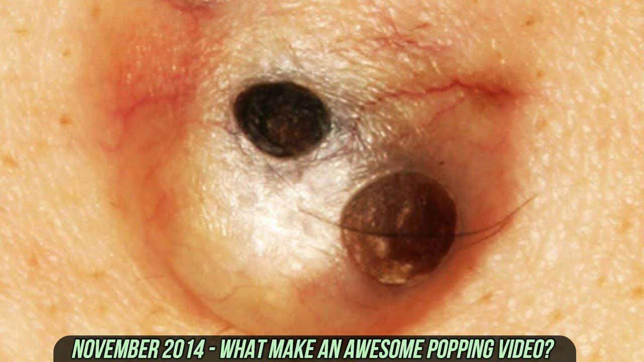 Dilated Pores and Blackheads!  What Makes a GREAT Popping Video?  (Part 2)