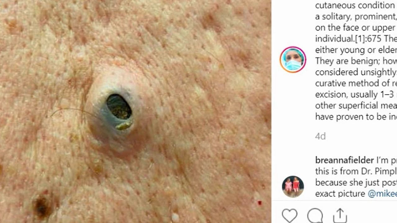 Dilated Pores of Winer, Navel Stones & Big Pimple Popping