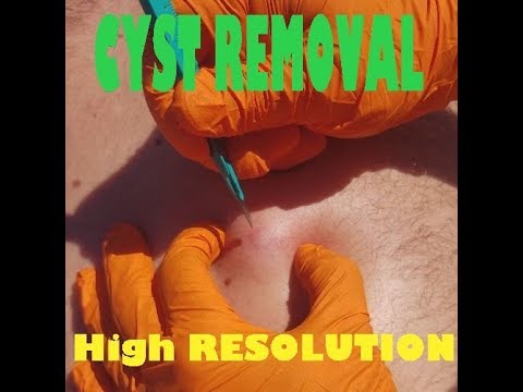 DISGUSTING Cyst Removal!! 4k Resolution!
