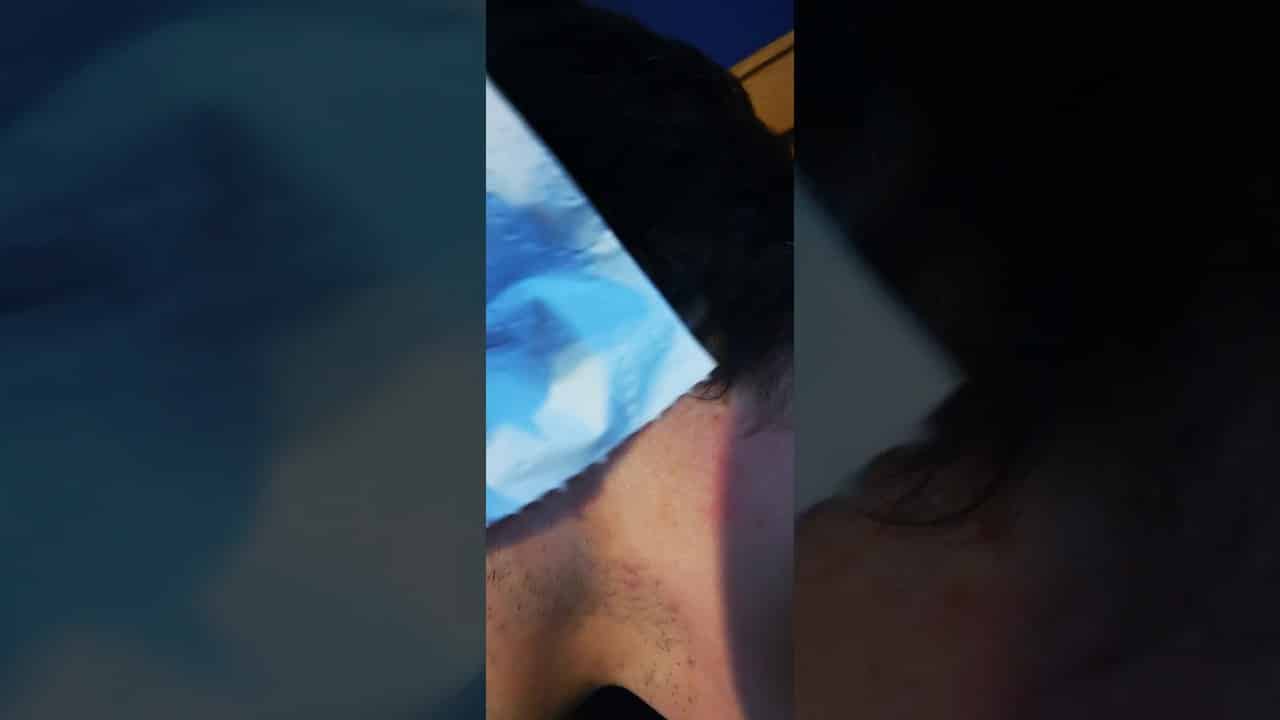 Disgusting cyst squeeze and pop…ewww!     #cyst #pop #puss #zit #stinks #satisfying