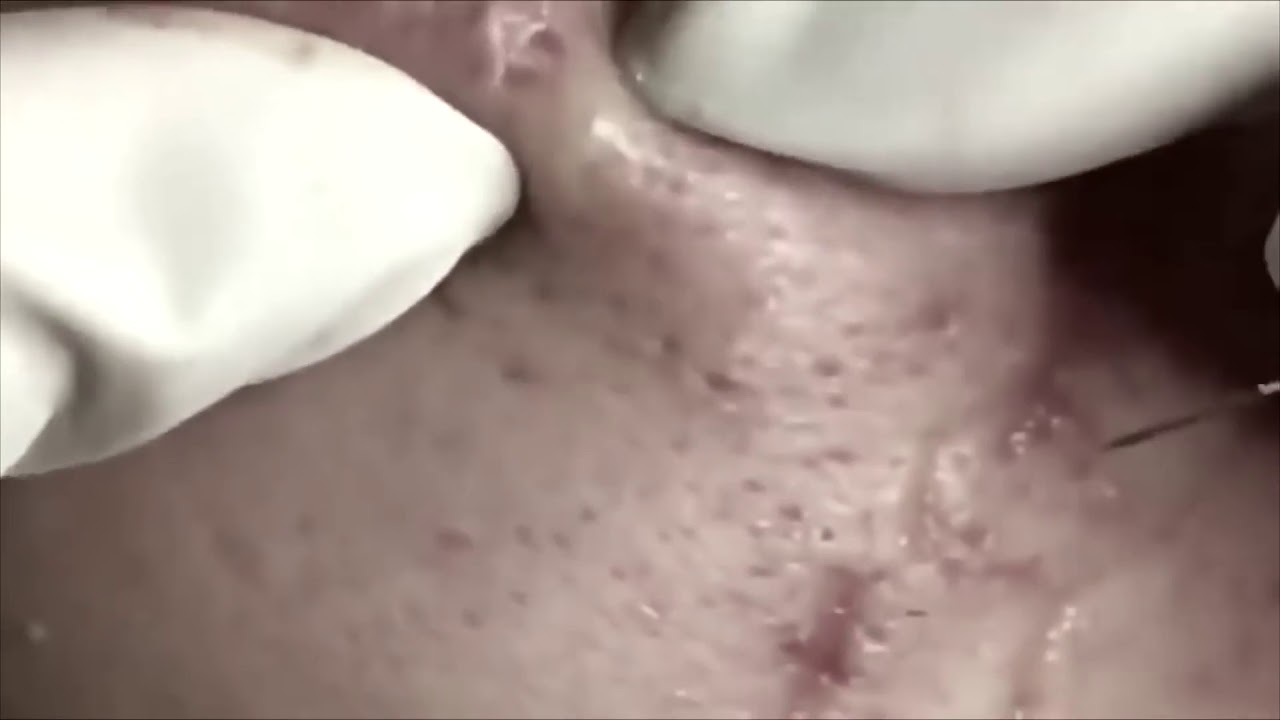 Disgusting huge pimple pop – Pimple ASMR – episode 11