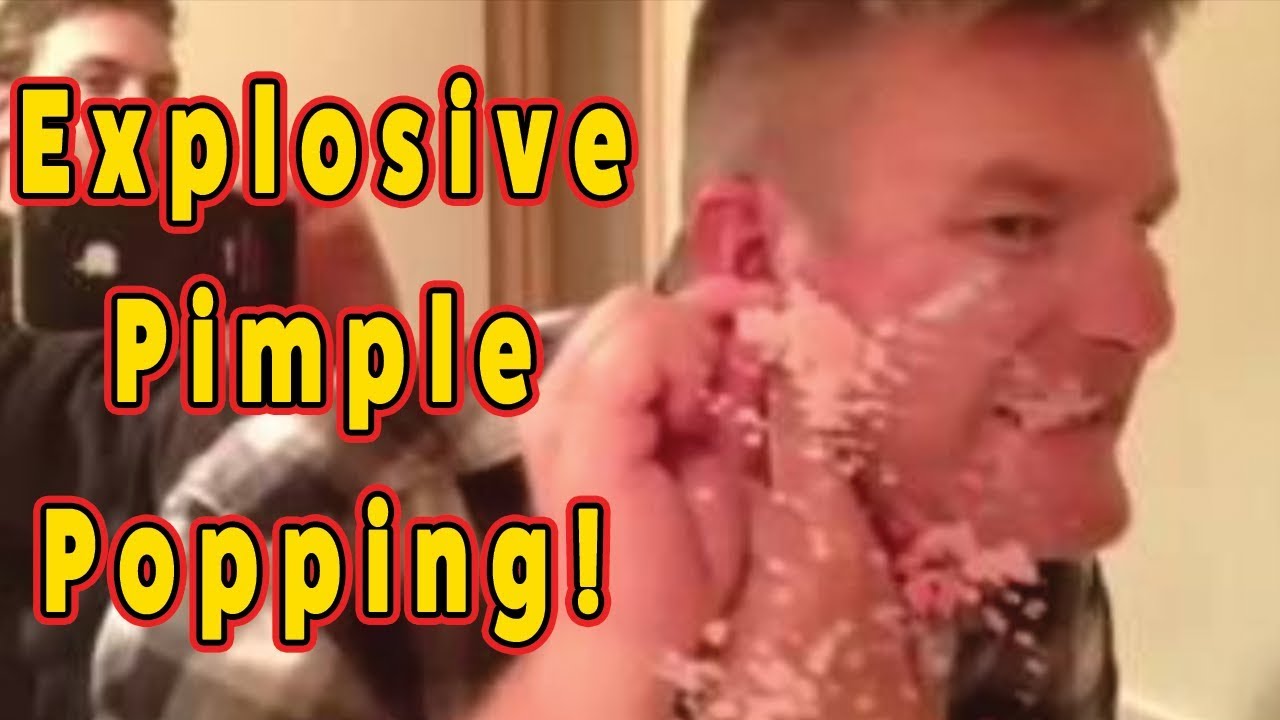DISGUSTING Pimple and Cyst Popping – VERY Explosive!