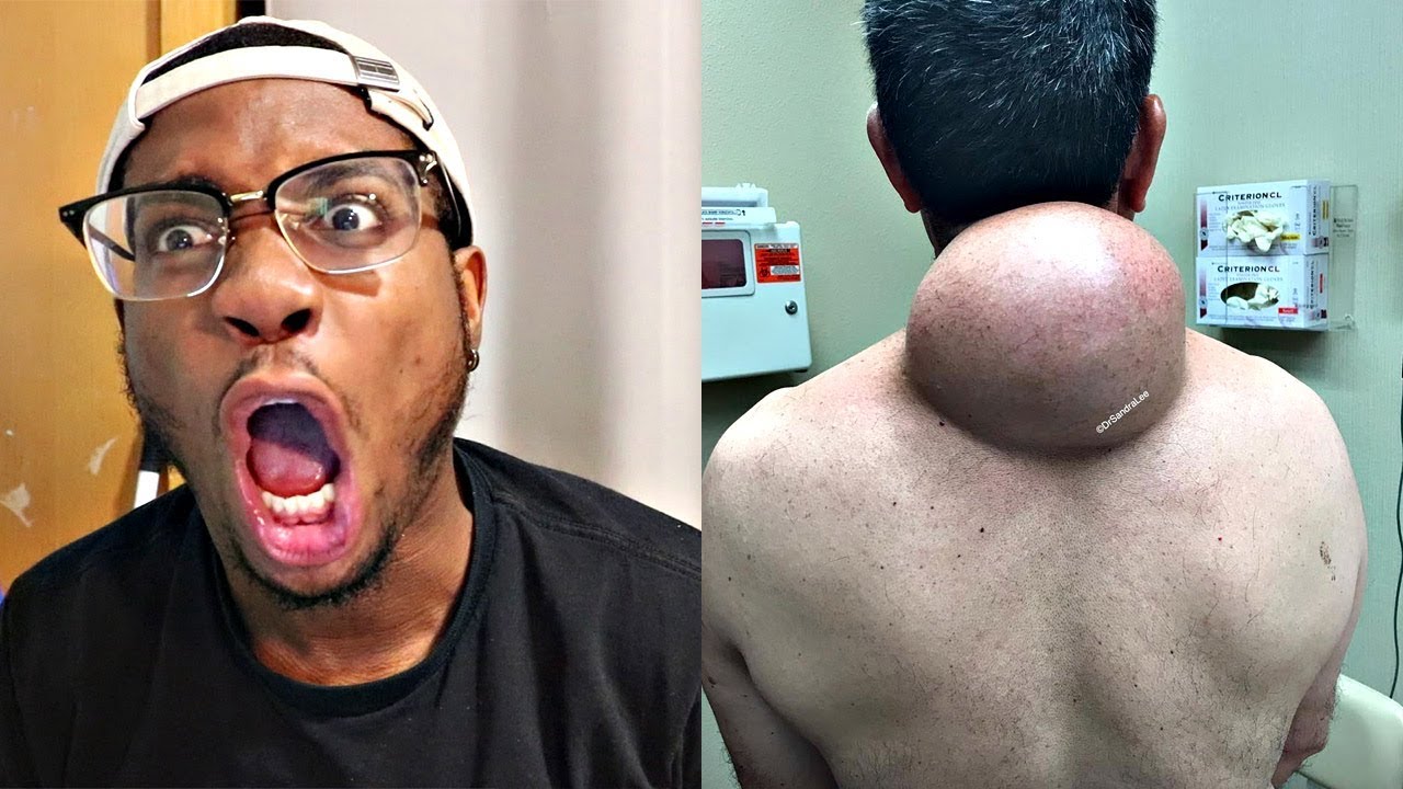 DISGUSTING PIMPLE POPPING COMPILATION!!!!